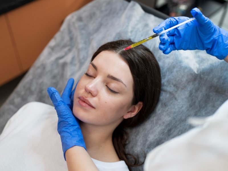 Exosome therapy preparation for hair treatment